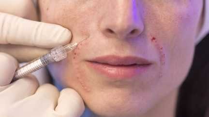 Stéphanie Rist déplore un « drame » après la mort d’une femme victime d’injections illégales de botox